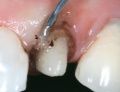 Жидкости для гемостаза и нити для ретракции Ultradent