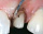 Жидкости для гемостаза и нити для ретракции Ultradent